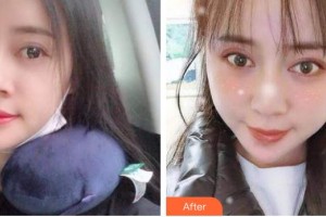 安康希顏醫(yī)療美容診所何紹其整形價(jià)格表附切開雙眼皮案例展示