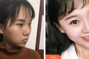 安康愛爾眼科醫(yī)院葉應(yīng)嘉整形價(jià)格表附切開雙眼皮案例展示