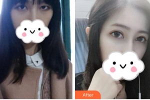 安康愛爾眼科醫(yī)院楊積文整形價(jià)格表附眼部綜合案例展示