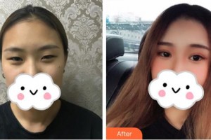 慶陽市第二人民醫(yī)院眼科楊國珍整形價格表附眼部綜合案例展示