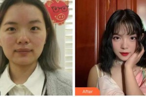 慶陽市第二人民醫(yī)院眼科徐璽凌整形價格表附開內(nèi)眼角案例展示