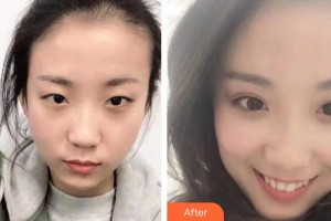 金昌市中西醫(yī)結(jié)合醫(yī)院眼科整形價(jià)格表附眼部綜合案例展示