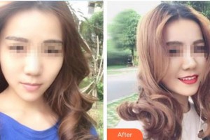 天水退休專家醫(yī)院醫(yī)療美容科何琪整形價(jià)格表附假體隆鼻案例展示