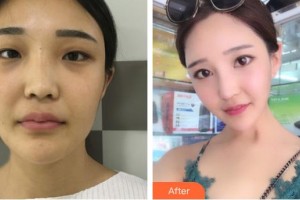 天水瑪莉亞（原女子）醫(yī)院醫(yī)學(xué)整形中心徐明整形價(jià)格表附鼻部綜合案例展示