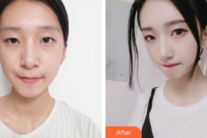 天水韓美整形美容門診部牛江艷整形價(jià)格表附埋線提升案例展示