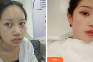 銀川鵬愛悅己醫(yī)療美容門診部羅奇整形價(jià)格表附埋線提升案例展示