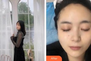 銀川慧頂醫(yī)學(xué)美容診所李鴻強(qiáng)整形價(jià)格表附黃金微針案例展示