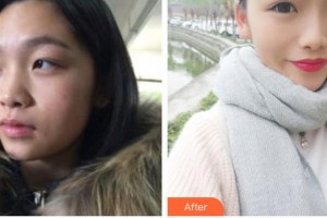 銀川鵬愛悅己醫(yī)療美容門診部劉丹萍整形價(jià)格表附埋線提升案例展示