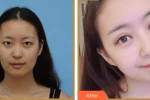 義烏愛爾眼科醫(yī)院戴襄軍整形價格表附眼部綜合案例展示