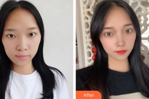 義烏視光眼科醫(yī)院高森整形價格表附眼部綜合案例展示