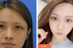 義烏視光眼科醫(yī)院杜爾罡整形價格表附眼部綜合案例展示