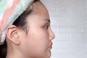 沈陽杏林美容整形醫(yī)院朱石江顴骨顴弓手術(shù)果咋樣？附果圖