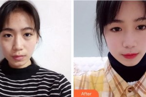 商洛中醫(yī)醫(yī)院燒傷整形科李寬民整形價(jià)格表附切開雙眼皮案例展示