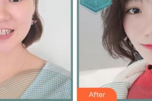 商洛市第二人民醫(yī)院眼科何平整形價(jià)格表附金屬托槽矯正案例展示