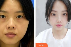 滕州時光醫(yī)療美容門診部許士海整形價格表附激光去眼袋案例展示