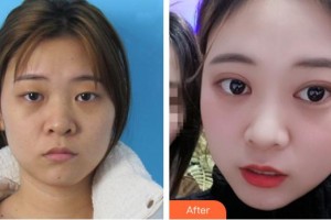 滕州市中心人民醫(yī)院燒傷整形美容科滿中亞整形價格表附切開雙眼皮案例展示