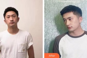 滕州美界醫(yī)療整形診所李承吉整形價格表附肋軟骨隆鼻案例展示