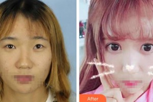 解放軍總醫(yī)院第一附屬醫(yī)院燒傷整形科盛志勇整形價格表附眼部綜合案例展示