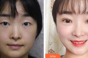 中國(guó)人民解放軍總政門診部醫(yī)學(xué)美容中心王世勇整形價(jià)格表附切開(kāi)雙眼皮案例展示