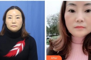 中國(guó)人民解放軍第四五七醫(yī)院陸海整形價(jià)格表附激光去眼袋案例展示