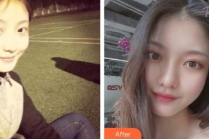 解放軍總裝備部后勤部醫(yī)學(xué)整形中心張殿祥整形價(jià)格表附開(kāi)內(nèi)眼角案例展示