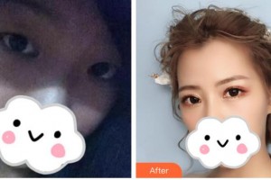 解放軍四五四醫(yī)院整形美容中心周吉玲整形價(jià)格表附眼部綜合案例展示