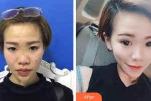 解放軍總裝備部后勤部醫(yī)學(xué)整形中心陳比較好的整形價(jià)格表附眼部綜合案例展示