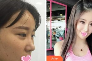 解放軍第一五八醫(yī)院整形美容中心張照日整形價格表附埋線提升案例展示