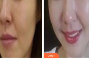 解放軍422醫(yī)院醫(yī)學(xué)整形美容中心查選平整形價格表附埋線提升案例展示