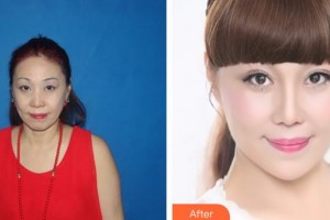 解放軍總裝備部后勤部醫(yī)學(xué)整形中心鐘華整形價(jià)格表附埋線提升案例展示