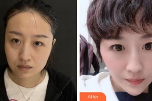 解放軍421醫(yī)院整形美容中心李新莉整形價格表附埋線提升案例展示