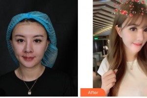 解放軍421醫(yī)院整形美容中心潘美櫻整形價格表附埋線提升案例展示