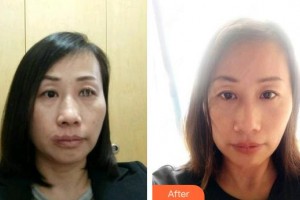 解放軍307醫(yī)院整形燒傷科金增強(qiáng)整形價格表附埋線提升案例展示