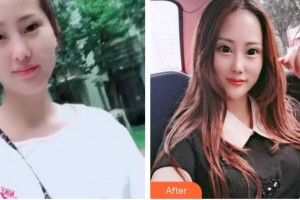 解放軍307醫(yī)院整形燒傷科馬驍整形價格表附埋線提升案例展示