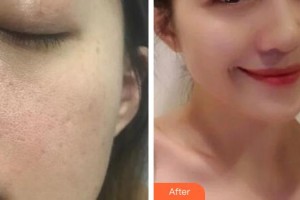 解放軍總醫(yī)院第一附屬醫(yī)院燒傷整形科李峰整形價格表附埋線提升案例展示