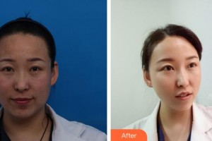 解放軍總醫(yī)院第一附屬醫(yī)院燒傷整形科賈曉明整形價格表附埋線提升案例展示