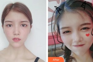 解放軍總醫(yī)院第一附屬醫(yī)院燒傷整形科吳焱秋整形價格表附埋線提升案例展示