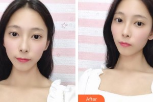 解放軍422醫(yī)院醫(yī)學(xué)整形美容中心鄭圣謨整形價格表附埋線提升案例展示