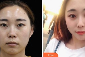 解放軍421醫(yī)院整形美容中心趙莉整形價格表附埋線提升案例展示