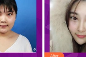 解放軍總醫(yī)院第一附屬醫(yī)院燒傷整形科李利根整形價(jià)格表附鼻部綜合案例展示