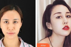 解放軍一八一醫(yī)院醫(yī)學(xué)整形美容科童亞林整形價(jià)格表附假體隆鼻案例展示