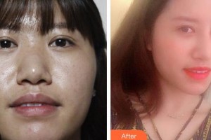 解放軍總醫(yī)院第一附屬醫(yī)院燒傷整形科楊紅明整形價(jià)格表附鼻部綜合案例展示