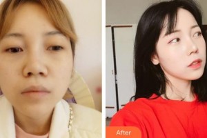 解放軍總醫(yī)院第一附屬醫(yī)院燒傷整形科郭振榮整形價(jià)格表附假體隆鼻案例展示