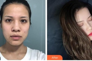 解放軍第三〇三醫(yī)院燒傷整形美容外科黃卓正整形價(jià)格表附鼻部綜合案例展示