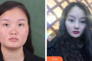 解放軍第一五八醫(yī)院整形美容中心刁樹(shù)信整形價(jià)格表附鼻部綜合案例展示