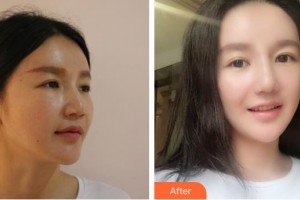 中國(guó)人民解放軍第一六三醫(yī)院整形美容中心劉麗芳整形價(jià)格表附假體隆鼻案例展示