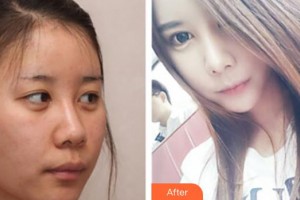 中國(guó)人民解放軍第一六三醫(yī)院整形美容中心易文林整形價(jià)格表附膨體隆鼻案例展示