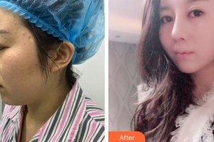 解放軍474醫(yī)院激光美容中心李紅整形價(jià)格表附鼻翼縮小案例展示