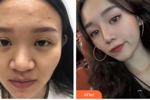 解放軍105醫(yī)院整形美容中心賈亮整形價(jià)格表附鼻部綜合案例展示