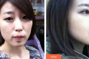 中國(guó)人民解放軍第100醫(yī)院整形美容中心樊彥奇整形價(jià)格表附埋線提升案例展示